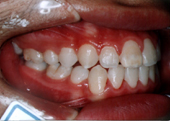 歯科矯正治療後写真