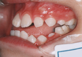 歯科矯正治療前写真