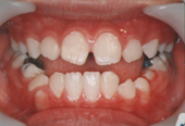 歯科矯正治療前写真