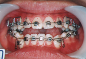 歯科矯正治療中写真