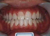 歯科矯正治療後写真